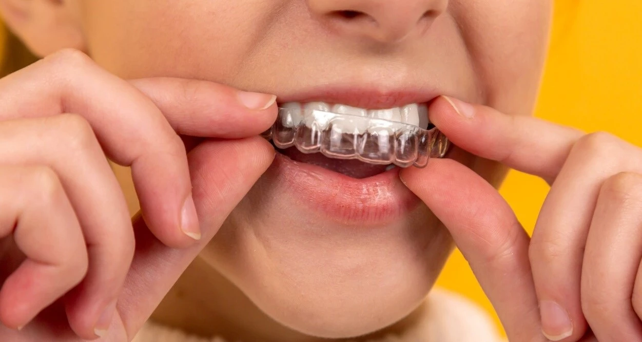 overbite dental braces