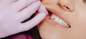 overbite in teeth