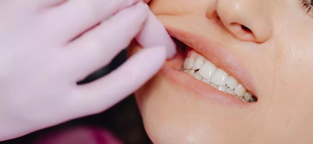 overbite in teeth